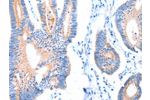 The image on the left is immunohistochemistry of paraffin-embedded Human colon cancer tissue using CSB-PA957686(ACADS Antibody) at dilution 1/20, on the right is treated with fusion protein. (Original magnification: 