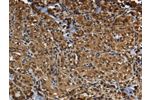 The image on the left is immunohistochemistry of paraffin-embedded Human thyroid cancer tissue using CSB-PA957737(GLO1 Antibody) at dilution 1/50, on the right is treated with fusion protein. (Original magnification: 