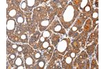 The image on the left is immunohistochemistry of paraffin-embedded Human thyroid cancer tissue using CSB-PA958000(ARFGAP2 Antibody) at dilution 1/35, on the right is treated with synthetic peptide. (Original magnification: 
