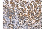 The image on the left is immunohistochemistry of paraffin-embedded Human gastic cancer tissue using CSB-PA958029(DOK4 Antibody) at dilution 1/60, on the right is treated with fusion protein. (Original magnification: 