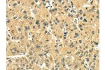 The image on the left is immunohistochemistry of paraffin-embedded Human esophagus cancer tissue using CSB-PA958222(EGLN1 Antibody) at dilution 1/20, on the right is treated with fusion protein. (Original magnification: 