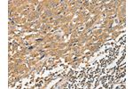The image on the left is immunohistochemistry of paraffin-embedded Human esophagus cancer tissue using CSB-PA958339(ANGPTL7 Antibody) at dilution 1/40, on the right is treated with fusion protein. (Original magnification: 