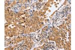 The image on the left is immunohistochemistry of paraffin-embedded Human lung cancer tissue using CSB-PA958582(BLNK Antibody) at dilution 1/50, on the right is treated with synthetic peptide. (Original magnification: 