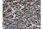 The image on the left is immunohistochemistry of paraffin-embedded Human gastic cancer tissue using CSB-PA958648(FTO Antibody) at dilution 1/60, on the right is treated with fusion protein. (Original magnification: 