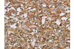 The image on the left is immunohistochemistry of paraffin-embedded Human thyroid cancer tissue using CSB-PA958803(DBH Antibody) at dilution 1/50, on the right is treated with fusion protein. (Original magnification: 