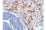 The image on the left is immunohistochemistry of paraffin-embedded Human liver cancer tissue using CSB-PA959008(CCNB1 Antibody) at dilution 1/20, on the right is treated with synthetic peptide. (Original magnification: 