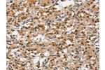 The image on the left is immunohistochemistry of paraffin-embedded Human thyroid cancer tissue using CSB-PA959149(ANAPC4 Antibody) at dilution 1/30, on the right is treated with synthetic peptide. (Original magnification: 