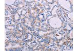 The image on the left is immunohistochemistry of paraffin-embedded Human thyroid cancer tissue using CSB-PA959270(AGT Antibody) at dilution 1/30, on the right is treated with synthetic peptide. (Original magnification: 