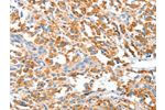 The image on the left is immunohistochemistry of paraffin-embedded Human thyroid cancer tissue using CSB-PA959352(CLIP1 Antibody) at dilution 1/20, on the right is treated with fusion protein. (Original magnification: 