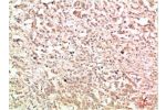 Immunohistochemical analysis of paraffin-embedded Human Breast Carcinoma Tissue using c-Abl Rabbit pAb diluted at 1:200