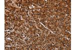 The image on the left is immunohistochemistry of paraffin-embedded Human prostate cancer tissue using CSB-PA959682(ACP6 Antibody) at dilution 1/30, on the right is treated with fusion protein. (Original magnification: 