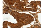The image on the left is immunohistochemistry of paraffin-embedded Human colon cancer tissue using CSB-PA959823(CEACAM21 Antibody) at dilution 1/60, on the right is treated with fusion protein. (Original magnification: 