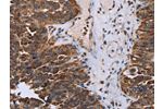 The image on the left is immunohistochemistry of paraffin-embedded Human ovarian cancer tissue using CSB-PA960020(DDX11 Antibody) at dilution 1/30, on the right is treated with fusion protein. (Original magnification: 