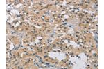 The image on the left is immunohistochemistry of paraffin-embedded Human thyroid cancer tissue using CSB-PA960251(FOSB Antibody) at dilution 1/20, on the right is treated with synthetic peptide. (Original magnification: 