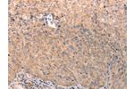 The image on the left is immunohistochemistry of paraffin-embedded Human cervical cancer tissue using CSB-PA960487(ABCF2 Antibody) at dilution 1/15, on the right is treated with fusion protein. (Original magnification: 