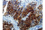 The image on the left is immunohistochemistry of paraffin-embedded Human renal cancer tissue using CSB-PA960585(AGR2 Antibody) at dilution 1/10, on the right is treated with fusion protein. (Original magnification: 