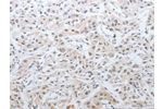 The image on the left is immunohistochemistry of paraffin-embedded Human lung cancer tissue using CSB-PA960924(DNAJC7 Antibody) at dilution 1/25, on the right is treated with fusion protein. (Original magnification: 