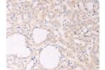 The image on the left is immunohistochemistry of paraffin-embedded Human thyroid cancer tissue using CSB-PA960978(F7 Antibody) at dilution 1/30, on the right is treated with fusion protein. (Original magnification: 
