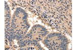 The image on the left is immunohistochemistry of paraffin-embedded Human colon cancer tissue using CSB-PA961022(BAIAP2 Antibody) at dilution 1/50, on the right is treated with fusion protein. (Original magnification: 