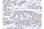 The image on the left is immunohistochemistry of paraffin-embedded Human breast cancer tissue using CSB-PA961180(ARF4 Antibody) at dilution 1/20, on the right is treated with fusion protein. (Original magnification: 
