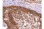 The image on the left is immunohistochemistry of paraffin-embedded Human cervical cancer tissue using CSB-PA961270(ABI1 Antibody) at dilution 1/40, on the right is treated with synthetic peptide. (Original magnification: 