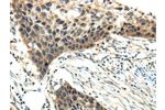 The image on the left is immunohistochemistry of paraffin-embedded Human esophagus cancer tissue using CSB-PA961371(EFNA3 Antibody) at dilution 1/20, on the right is treated with fusion protein. (Original magnification: 