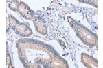 The image on the left is immunohistochemistry of paraffin-embedded Human colon cancer tissue using CSB-PA961708(ACVR1C Antibody) at dilution 1/15, on the right is treated with fusion protein. (Original magnification: 