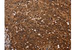 The image on the left is immunohistochemistry of paraffin-embedded Human cervical cancer tissue using CSB-PA962118(FANCF Antibody) at dilution 1/60, on the right is treated with fusion protein. (Original magnification: 