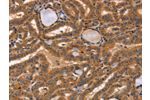 The image on the left is immunohistochemistry of paraffin-embedded Human thyroid cancer tissue using CSB-PA962305(CCL23 Antibody) at dilution 1/50, on the right is treated with synthetic peptide. (Original magnification: 