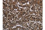 The image on the left is immunohistochemistry of paraffin-embedded Human liver cancer tissue using CSB-PA962337(GLIPR1 Antibody) at dilution 1/50, on the right is treated with fusion protein. (Original magnification: 