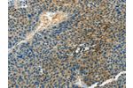 The image on the left is immunohistochemistry of paraffin-embedded Human liver cancer tissue using CSB-PA962705(DGKB Antibody) at dilution 1/60, on the right is treated with synthetic peptide. (Original magnification: 