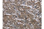 The image on the left is immunohistochemistry of paraffin-embedded Human liver cancer tissue using CSB-PA962996(GGCX Antibody) at dilution 1/50, on the right is treated with fusion protein. (Original magnification: 