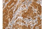 The image on the left is immunohistochemistry of paraffin-embedded Human gastic cancer tissue using CSB-PA963031(CENPE Antibody) at dilution 1/50, on the right is treated with synthetic peptide. (Original magnification: 