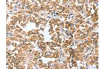 The image on the left is immunohistochemistry of paraffin-embedded Human thyroid cancer tissue using CSB-PA963186(CIAPIN1 Antibody) at dilution 1/60, on the right is treated with fusion protein. (Original magnification: 