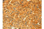 The image on the left is immunohistochemistry of paraffin-embedded Human liver cancer tissue using CSB-PA963389(GK Antibody) at dilution 1/60, on the right is treated with fusion protein. (Original magnification: 