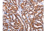 The image on the left is immunohistochemistry of paraffin-embedded Human thyroid cancer tissue using CSB-PA963716(AGTR2 Antibody) at dilution 1/15, on the right is treated with synthetic peptide. (Original magnification: 