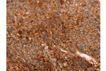 The image on the left is immunohistochemistry of paraffin-embedded Human liver cancer tissue using CSB-PA964049(GC Antibody) at dilution 1/40, on the right is treated with fusion protein. (Original magnification: 