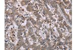 The image on the left is immunohistochemistry of paraffin-embedded Human liver cancer tissue using CSB-PA964117(EPSTI1 Antibody) at dilution 1/40, on the right is treated with fusion protein. (Original magnification: 