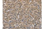 The image on the left is immunohistochemistry of paraffin-embedded Human thyroid cancer tissue using CSB-PA964373(AGTRAP Antibody) at dilution 1/40, on the right is treated with fusion protein. (Original magnification: 