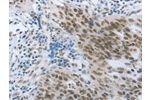 The image on the left is immunohistochemistry of paraffin-embedded Human ovarian cancer tissue using CSB-PA964463(ACIN1 Antibody) at dilution 1/30, on the right is treated with synthetic peptide. (Original magnification: 