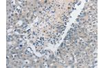 The image on the left is immunohistochemistry of paraffin-embedded Human breast cancer tissue using CSB-PA964562(GCH1 Antibody) at dilution 1/15, on the right is treated with synthetic peptide. (Original magnification: 