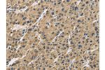 The image is immunohistochemistry of paraffin-embedded Human liver cancer tissue using CSB-PA965093(GAS7 Antibody) at dilution 1/30. (Original magnification: 