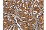 The image on the left is immunohistochemistry of paraffin-embedded Human gastic cancer tissue using CSB-PA965136(CEACAM3 Antibody) at dilution 1/30, on the right is treated with synthetic peptide. (Original magnification: 
