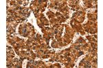 The image on the left is immunohistochemistry of paraffin-embedded Human liver cancer tissue using CSB-PA965818(GJA8 Antibody) at dilution 1/15, on the right is treated with synthetic peptide. (Original magnification: 