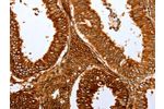 The image on the left is immunohistochemistry of paraffin-embedded Human cervical cancer tissue using CSB-PA966011(FOXN1  Antibody) at dilution 1/15, on the right is treated with synthetic peptide. (Original magnification: 