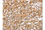 The image on the left is immunohistochemistry of paraffin-embedded Human thyroid cancer tissue using CSB-PA966173(CTAGE5 Antibody) at dilution 1/40, on the right is treated with fusion protein. (Original magnification: 