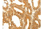 The image on the left is immunohistochemistry of paraffin-embedded Human colon cancer tissue using CSB-PA966330(DIABLO Antibody) at dilution 1/50, on the right is treated with fusion protein. (Original magnification: 