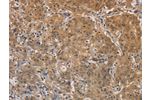 The image on the left is immunohistochemistry of paraffin-embedded Human gastic cancer tissue using CSB-PA966804(AGTRAP Antibody) at dilution 1/20, on the right is treated with fusion protein. (Original magnification: 