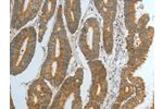 The image on the left is immunohistochemistry of paraffin-embedded Human colon cancer tissue using CSB-PA967082(DNAJC10 Antibody) at dilution 1/15, on the right is treated with fusion protein. (Original magnification: 