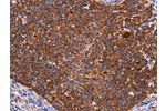 The image on the left is immunohistochemistry of paraffin-embedded Human cervical cancer tissue using CSB-PA967648(CROT Antibody) at dilution 1/50, on the right is treated with fusion protein. (Original magnification: 